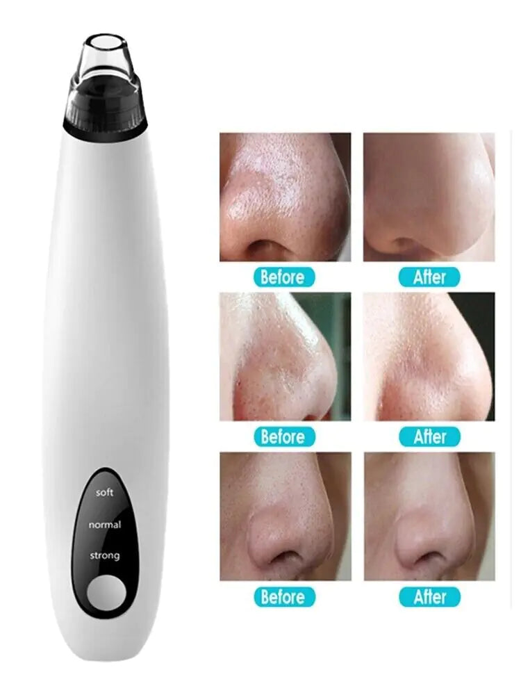 Electric Blackhead Remover